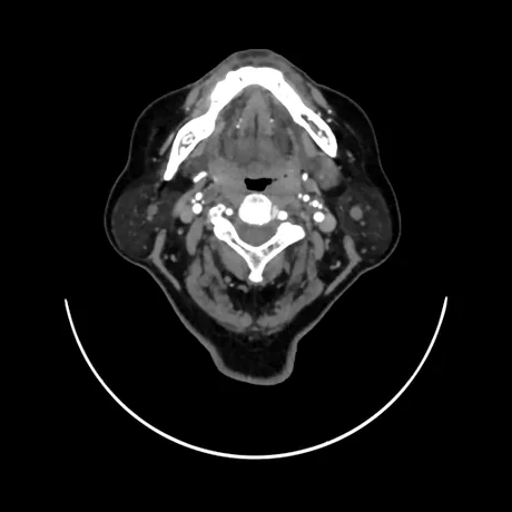 TC axial do pescoço na fase arterial: as carótidas de cada lado do eixo aéreo-digestivo e as artérias vertebrais dentro dos forames transversos, todas brancas de contraste.