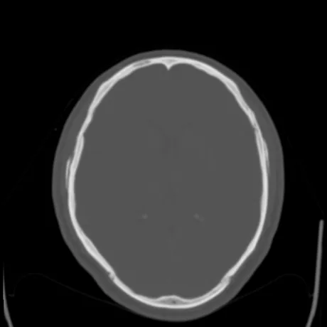 A mesma fatia em janela óssea: a calota craniana em alto contraste, com as tábuas interna e externa e as suturas; o cérebro fica uniforme.