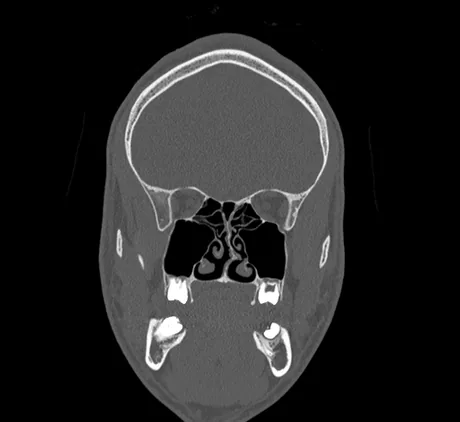Reformatação coronal em janela óssea dos seios da face: as órbitas em cima, as células etmoidais no centro, a cavidade nasal com septo e cornetos, e os seios maxilares como grandes cavidades aéreas abaixo das órbitas.