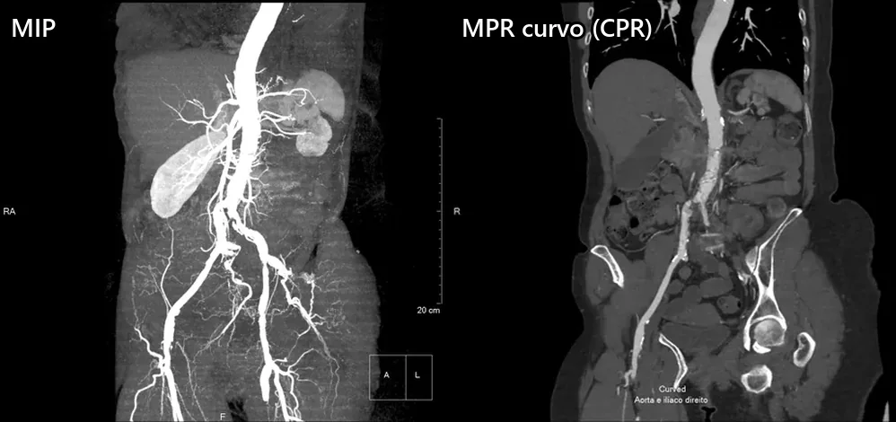 À esquerda, uma projeção de intensidade máxima (MIP) de angiotomografia mostrando a aorta abdominal e as artérias ilíacas como vasos brilhantes; à direita, uma reconstrução multiplanar curva (CPR) que retifica a aorta num único plano.