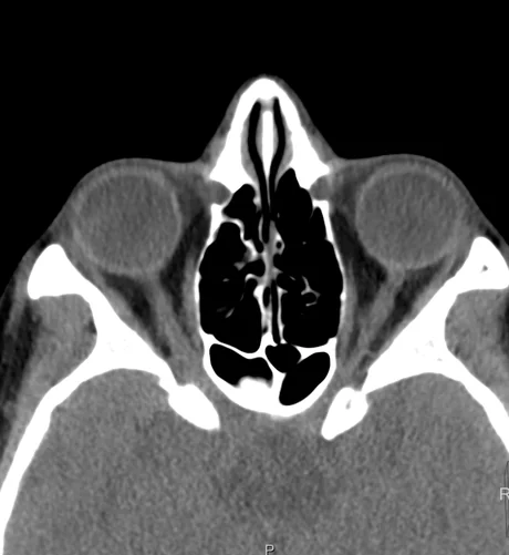 TC axial das órbitas em janela de partes moles, mostrando os globos, o nervo óptico, os músculos reto medial e lateral e as células etmoidais.
