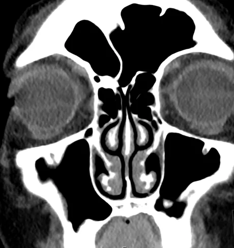 TC coronal das órbitas em janela de partes moles, mostrando os dois globos, os músculos extraoculares, a gordura orbitária, as células etmoidais e a cavidade nasal.
