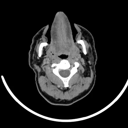 TC axial do pescoço com contraste ao nível da orofaringe, mostrando os espaços parafaríngeos, os vasos carotídeos e jugulares realçados e a coluna cervical.