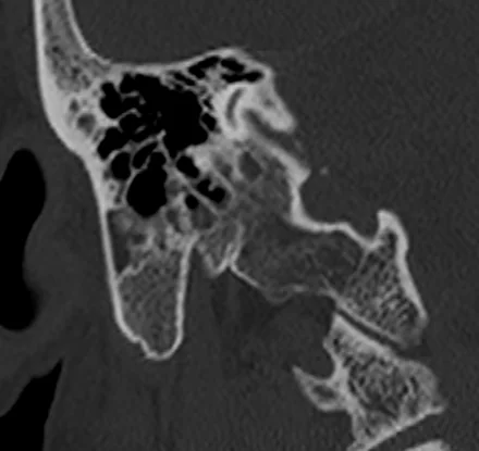 TC coronal reformatada em janela óssea do osso temporal, mostrando o teto do tímpano, o esporão, a orelha média e as células mastóideas, com a articulação temporomandibular abaixo.
