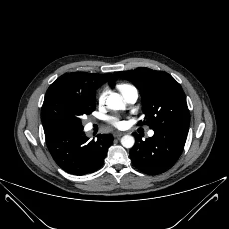 TC axial de tórax na fase arterial pulmonar, janela de mediastino: o tronco e as artérias pulmonares direita e esquerda cheias de contraste, brancas, ramificando-se no mediastino.