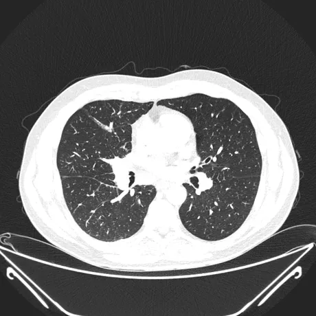 A mesma fatia axial em janela de pulmão: o parênquima pulmonar, onde se procuram infarto em cunha e oligoemia associados ao TEP.