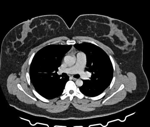 TC de tórax axial em janela de mediastino: coração, grandes vasos e partes moles em tons de cinza; pulmões pretos.