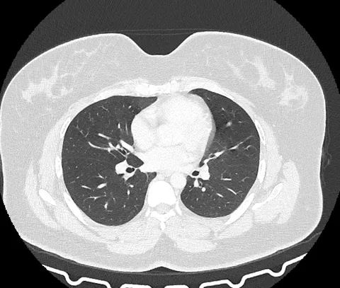 TC de tórax axial em janela de pulmão com kernel afiado: parênquima com vasos e brônquios nítidos ramificando-se até a periferia.