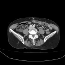 Tomografia de abdome, corte axial (fase portal)