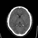 Tomografia de crânio, corte axial (janela de encéfalo)