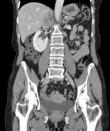Reformatação coronal em tomografia