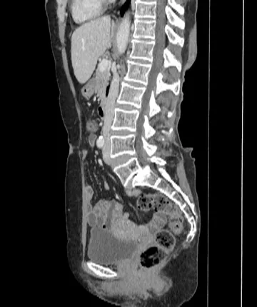 Reformatação sagital em tomografia